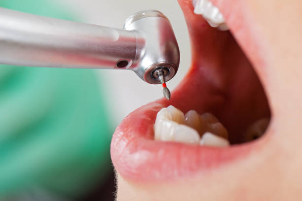 Best Emergency Tooth Extraction in Norman Park, GA
